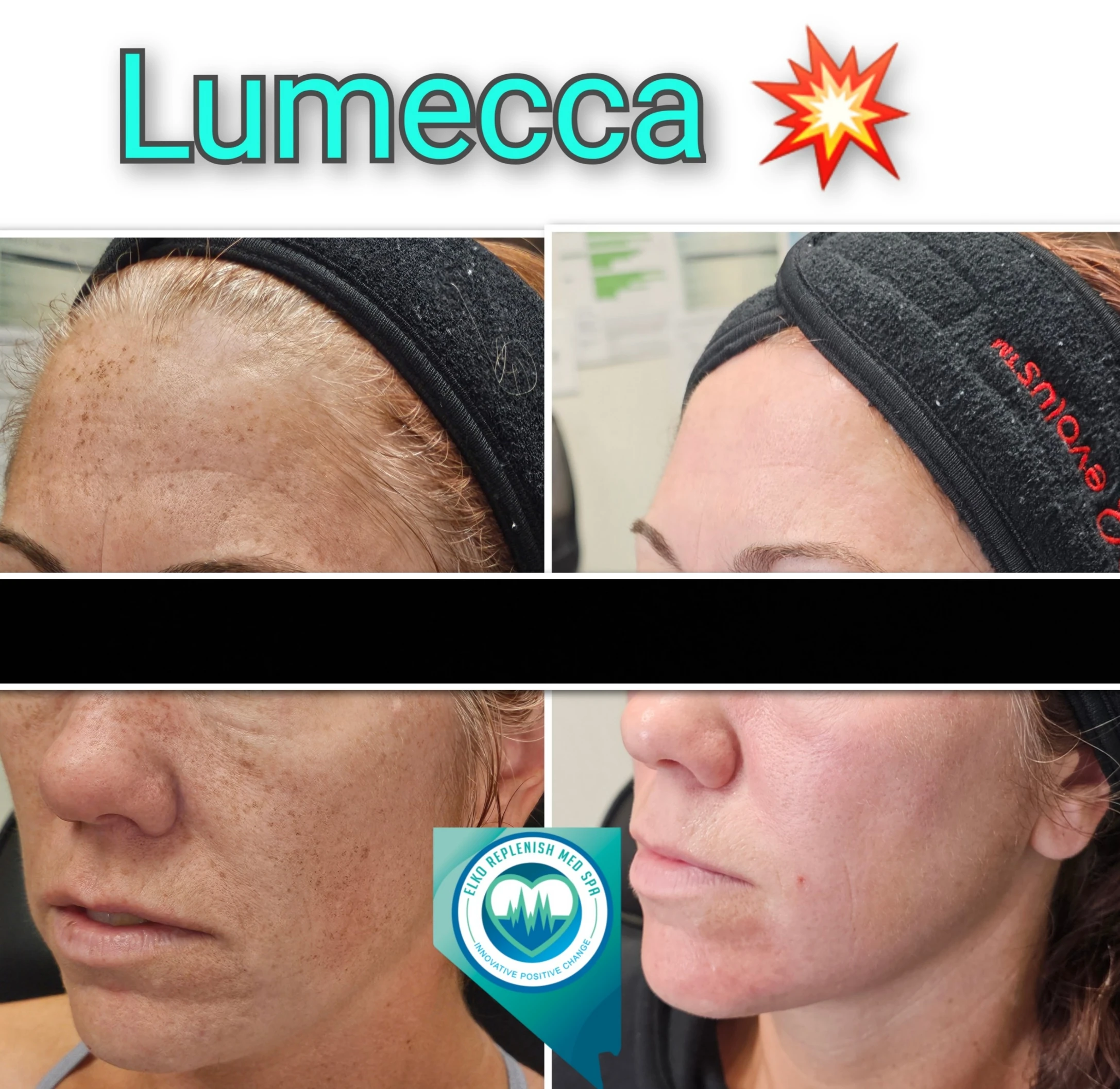 Lumecca IPL Treatment before and after images 7 | Elko Replenish Med Spa | Elko, NV