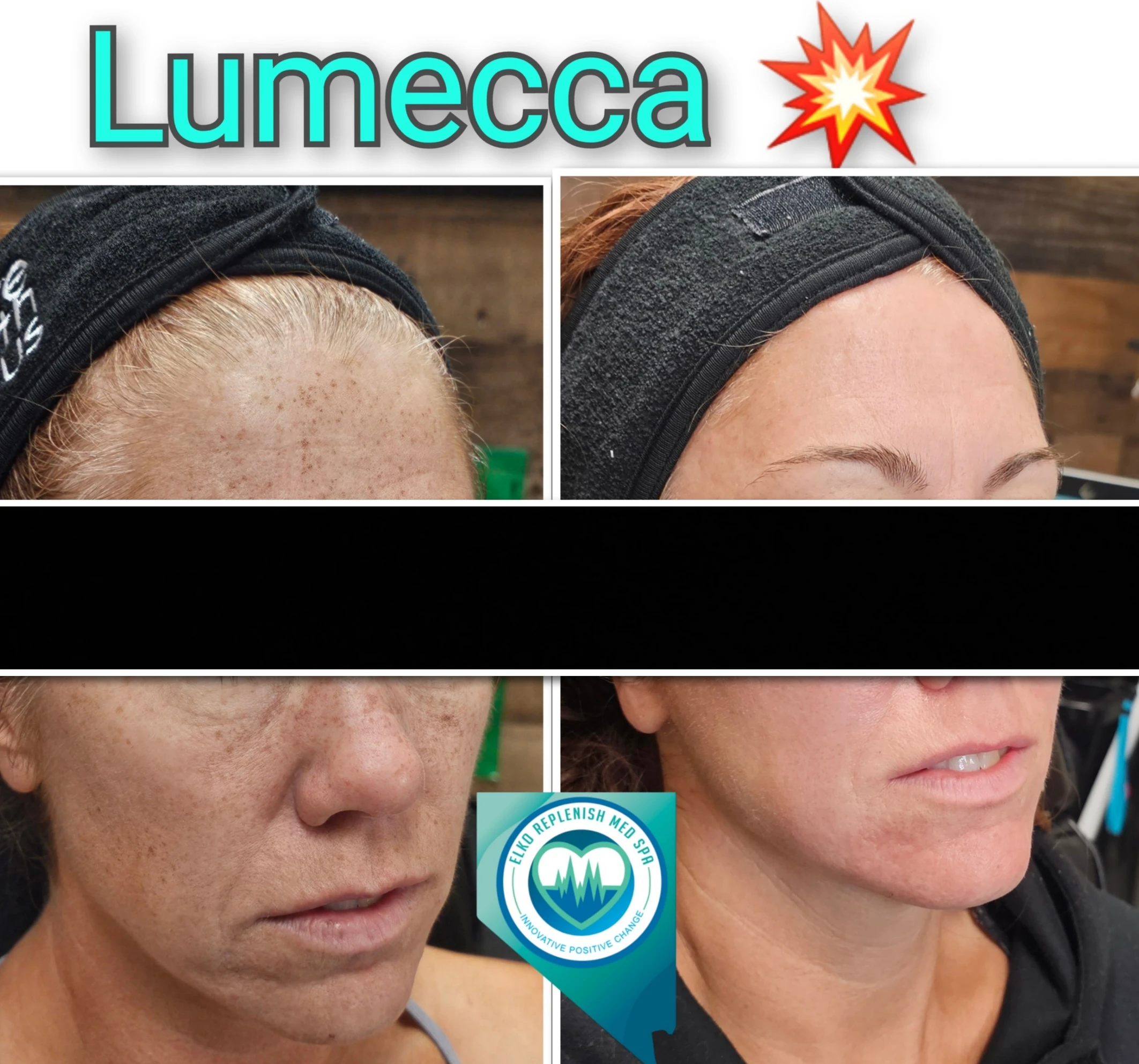 Lumecca IPL Treatment before and after images 6 | Elko Replenish Med Spa | Elko, NV