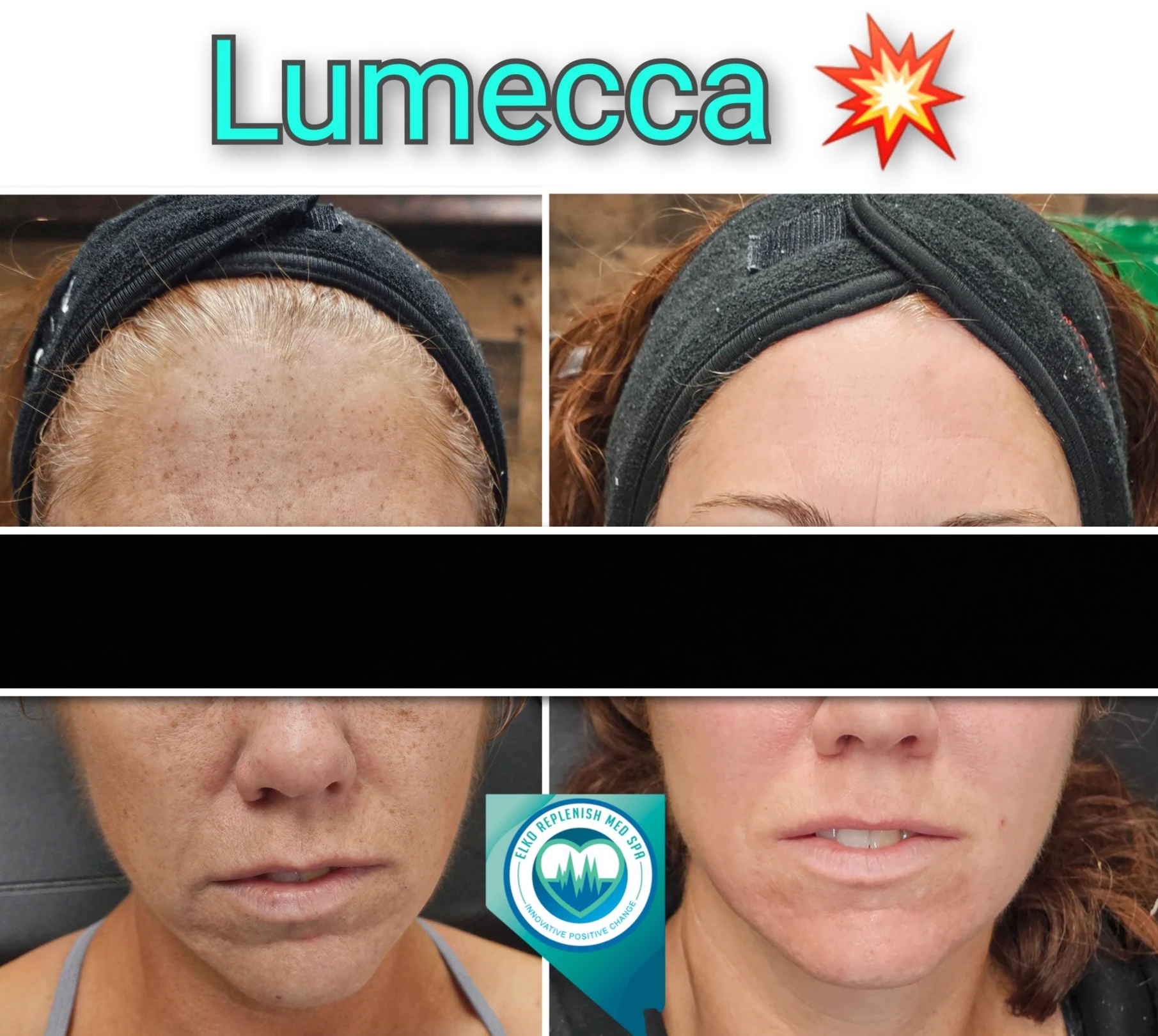 Lumecca IPL Treatment before and after images 4 | Elko Replenish Med Spa | Elko, NV