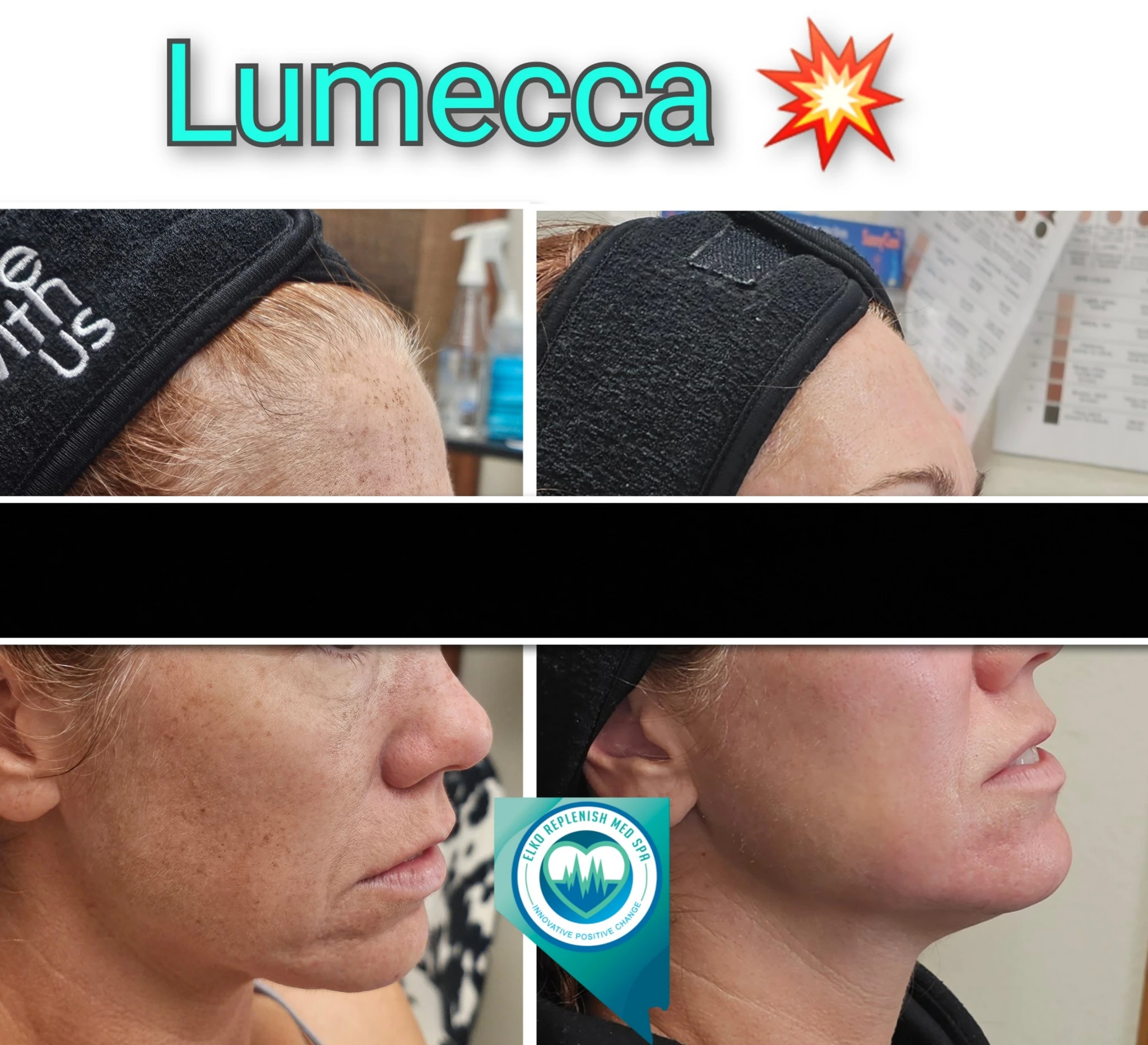 Lumecca IPL Treatment before and after images 2 | Elko Replenish Med Spa | Elko, NV