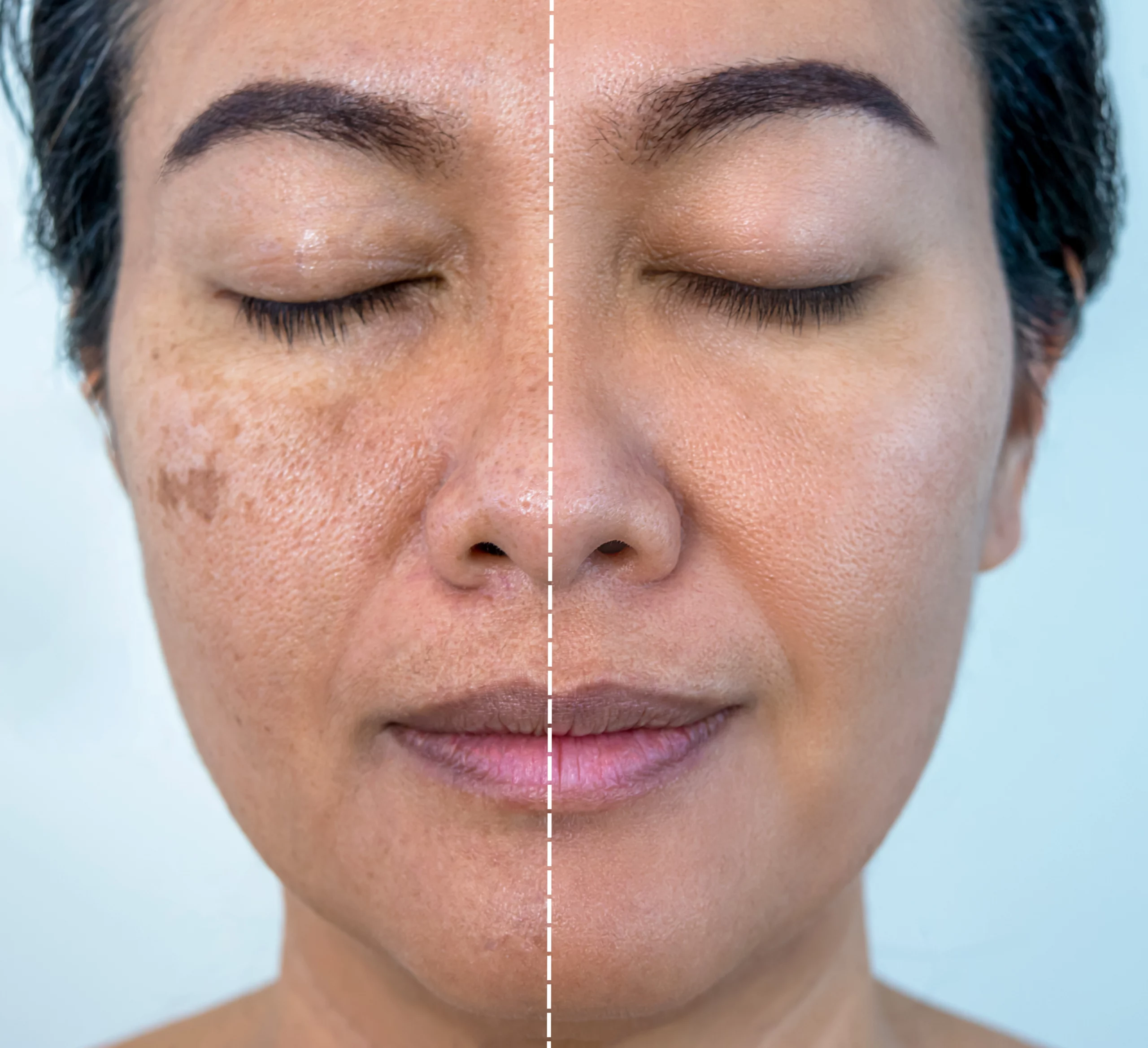 Hyperpigmentation | Elko Replenish Med Spa | Elko, NV