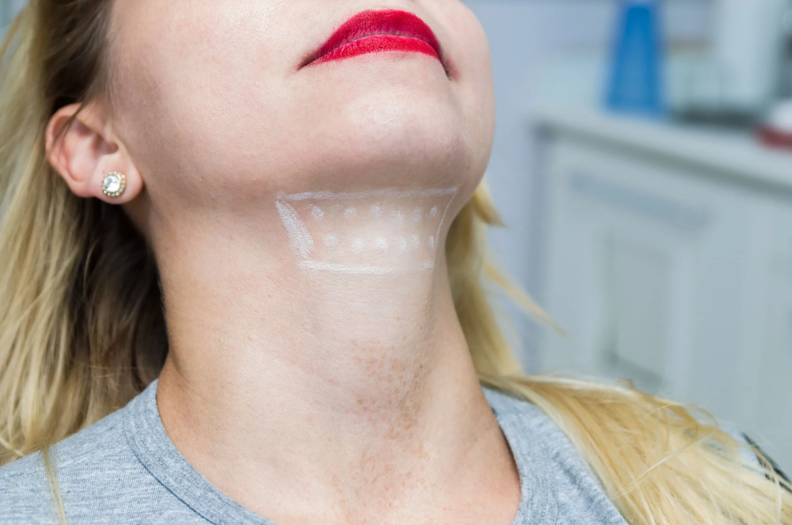 Kybella Injections | Elko Replenish Med Spa | Elko, NV