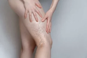 Vasculaze Treatment by Elko Replenish Med Spa in Elko, NV
