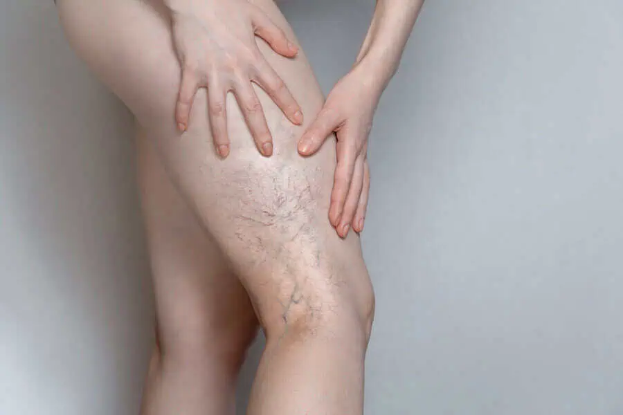 Vasculaze Treatment by Elko Replenish Med Spa in Elko, NV