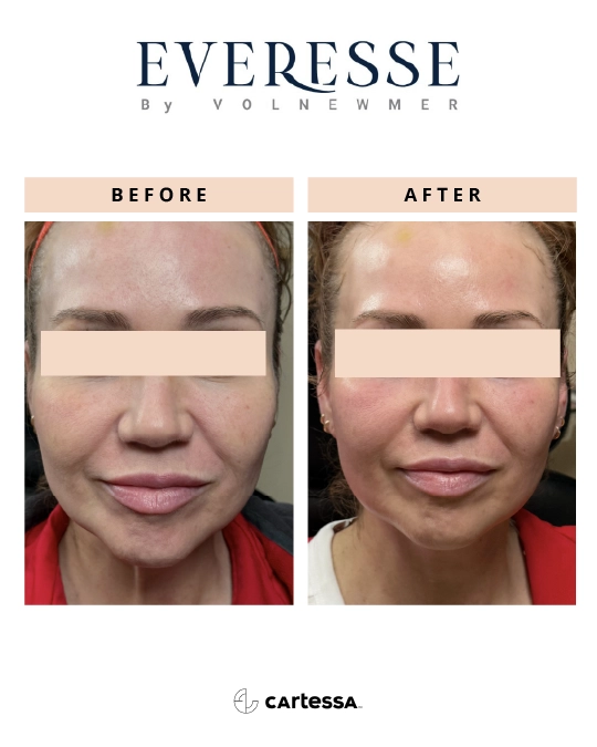 Everesse™-Before-and-After-02