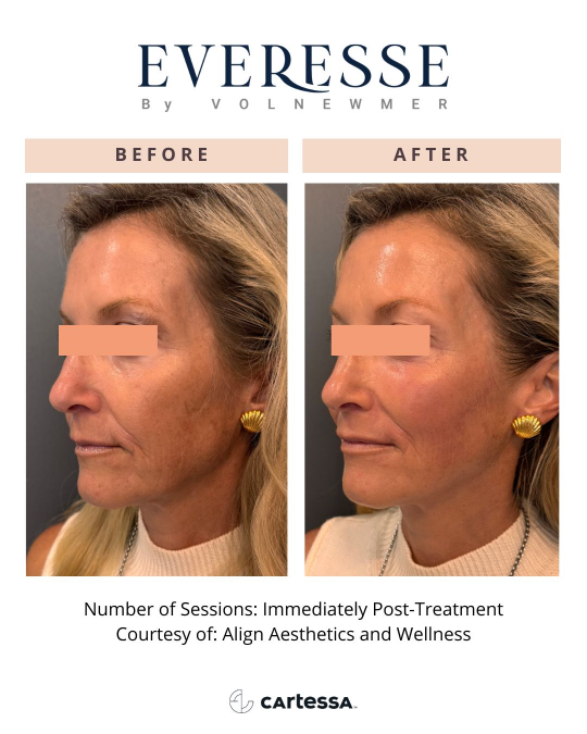 Everesse™ Before and After 1