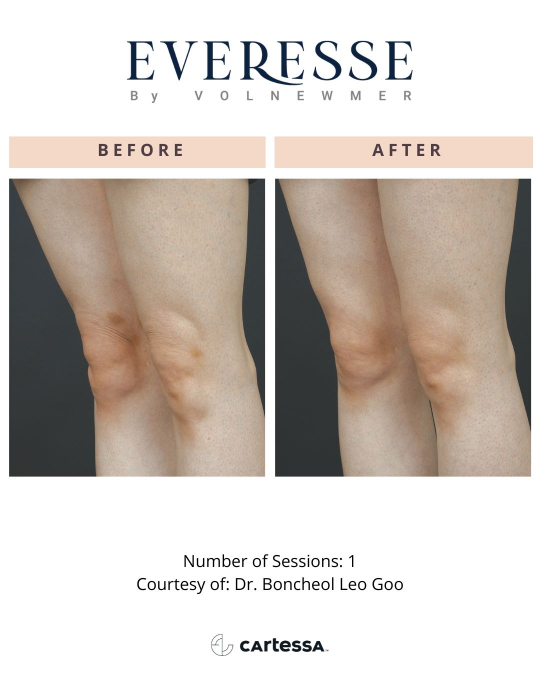 Everesse™ Before and After 10