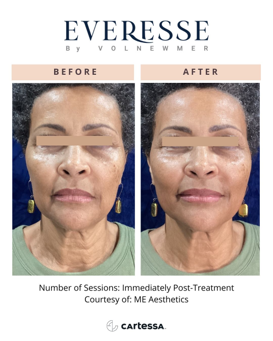 Everesse™ Before and After 11