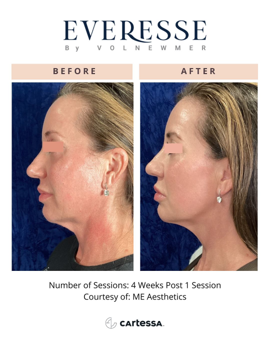 Everesse™ Before and After 12
