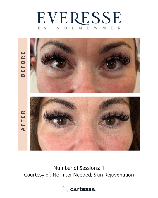 Everesse™ Before and After 13