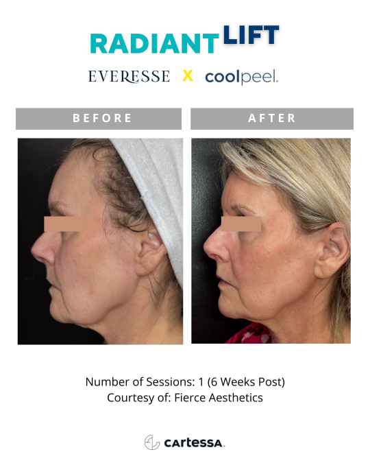 Everesse™ Before and After 14