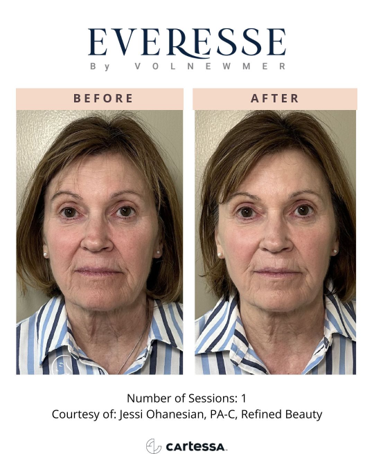 Everesse™ Before and After 15