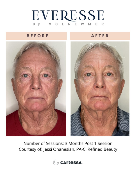 Everesse™ Before and After 16