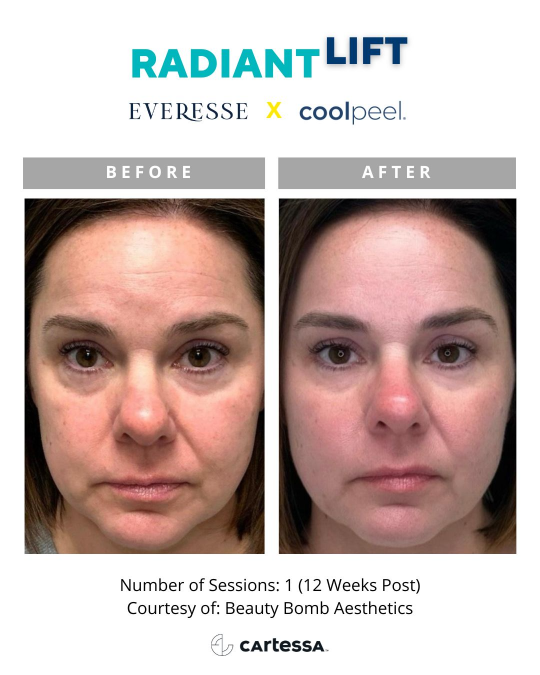 Everesse™ Before and After 4