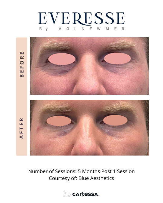 Everesse™ Before and After 5