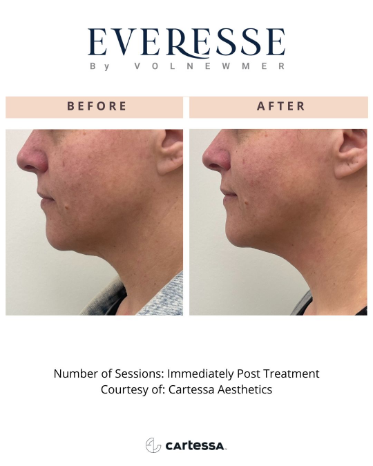 Everesse™ Before and After 6