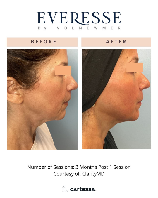 Everesse™ Before and After 7