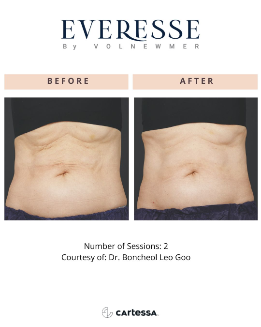 Everesse™ Before and After 8