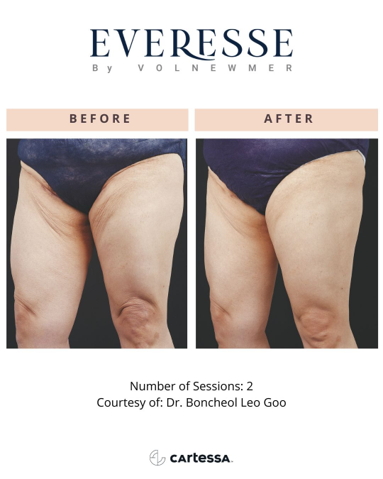 Everesse™ Before and After 9