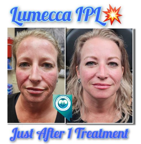 Lumecca IPL Before and After Images 6 | Elko Replenish Med Spa | Elko, NV