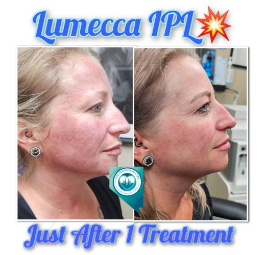 Lumecca IPL Before and After Images 9 | Elko Replenish Med Spa | Elko, NV