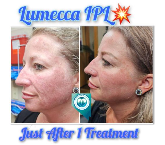 Lumecca IPL Before and After Images 7 | Elko Replenish Med Spa | Elko, NV