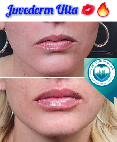 Juvederm lips Before and After Images | Elko Replenish Med Spa | Elko, NV