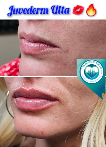 Juvederm lips Before and After Images | Elko Replenish Med Spa | Elko, NV