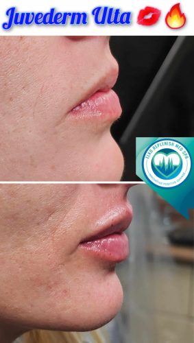 Juvederm lips Before and After Images | Elko Replenish Med Spa | Elko, NV