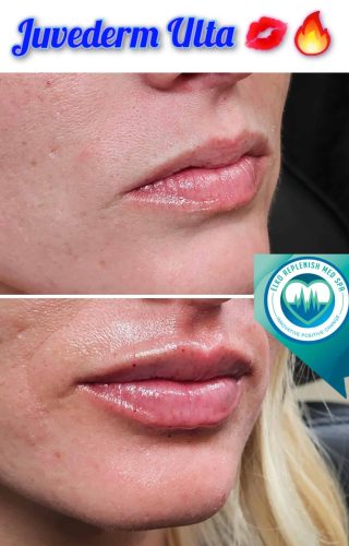 Juvederm lips Before and After Images | Elko Replenish Med Spa | Elko, NV