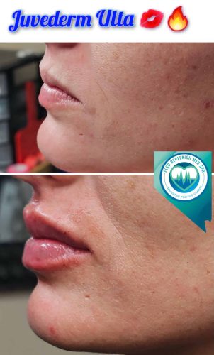 Juvederm lips Before and After Images | Elko Replenish Med Spa | Elko, NV