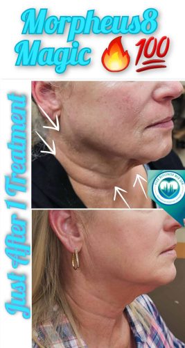 Mprpheus8 Treatment Before and After Images | Elko Replenish Med Spa | Elko, NV