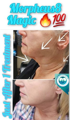 Mprpheus8 Treatment Before and After Images | Elko Replenish Med Spa | Elko, NV