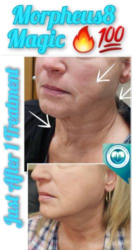 Mprpheus8 Treatment Before and After Images | Elko Replenish Med Spa | Elko, NV