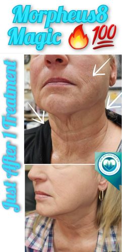 Mprpheus8 Treatment Before and After Images | Elko Replenish Med Spa | Elko, NV