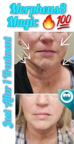 Mprpheus8 Treatment Before and After Images | Elko Replenish Med Spa | Elko, NV