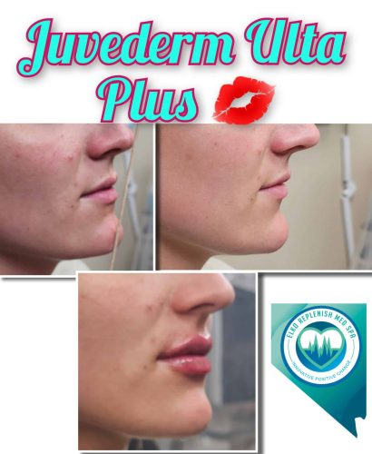 Juvederm lip filler treatment Before and After Images | Elko Replenish Med Spa | Elko, NV