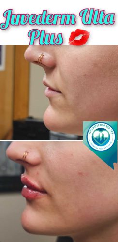 Juvederm lips Before and After Images | Elko Replenish Med Spa | Elko, NV