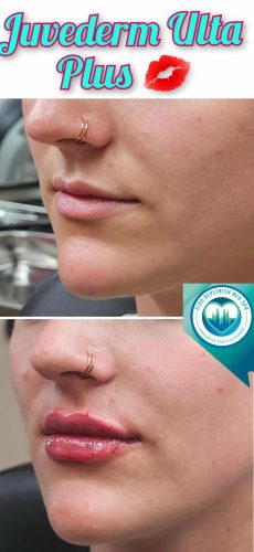 Juvederm lips Before and After Images | Elko Replenish Med Spa | Elko, NV