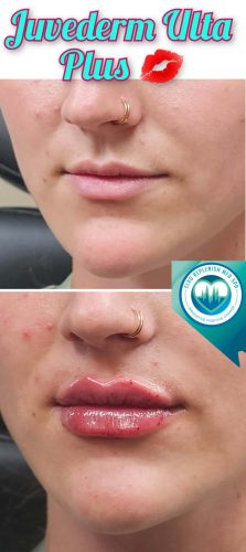 Juvederm lip filler Before and After Images | Elko Replenish Med Spa | Elko, NV