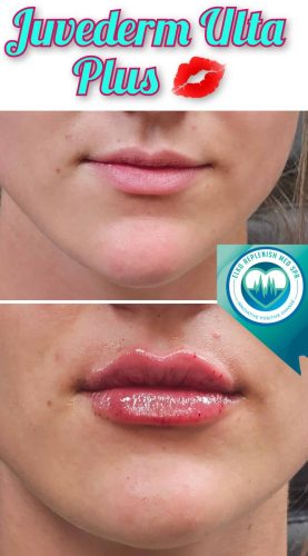 Juvederm lips Before and After Images | Elko Replenish Med Spa | Elko, NV