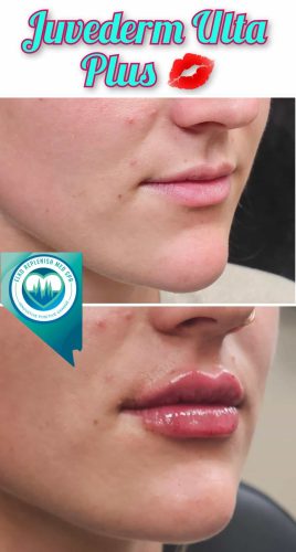 Juvederm lips Before and After Images | Elko Replenish Med Spa | Elko, NV