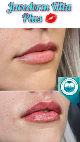 Juvederm lips Before and After Images | Elko Replenish Med Spa | Elko, NV