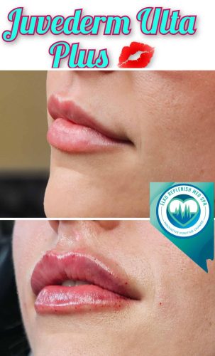 Juvederm lips Treatment Before and After Images | Elko Replenish Med Spa | Elko, NV