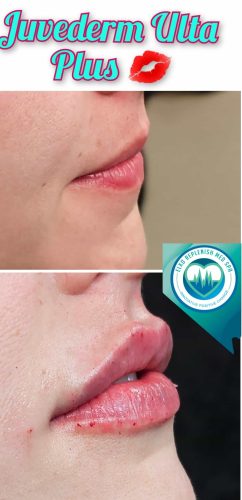 Juvederm lip fillers Before and After Images | Elko Replenish Med Spa | Elko, NV