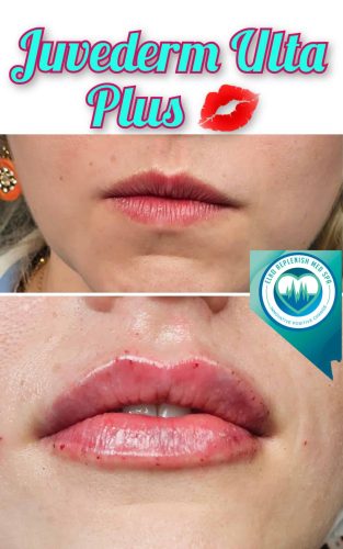 Juvederm lip Filler Before and After Images | Elko Replenish Med Spa | Elko, NV