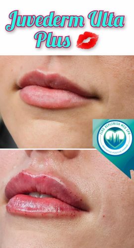 Juvederm lips Before and After Images | Elko Replenish Med Spa | Elko, NV