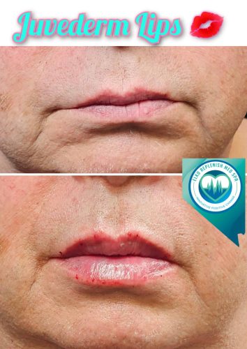 Juvederm lips Before and After Images | Elko Replenish Med Spa | Elko, NV