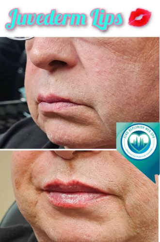 Juvederm lips Before and After Images | Elko Replenish Med Spa | Elko, NV