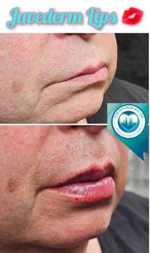 Juvederm lip filler Before and After Images | Elko Replenish Med Spa | Elko, NV